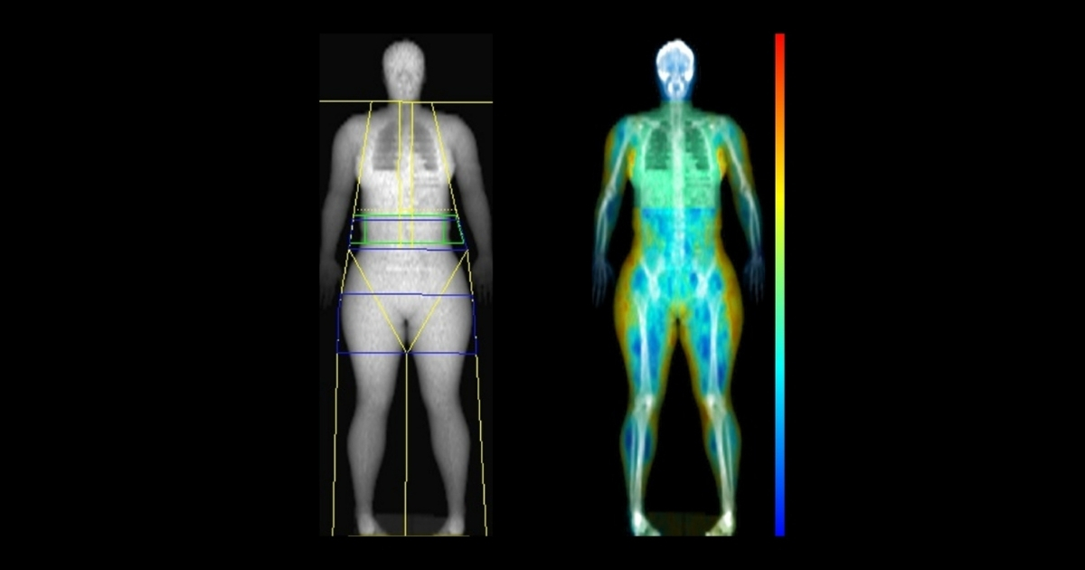 Full Body Composition DEXA Scan in Malta — What to Expect | LifeScan Guide